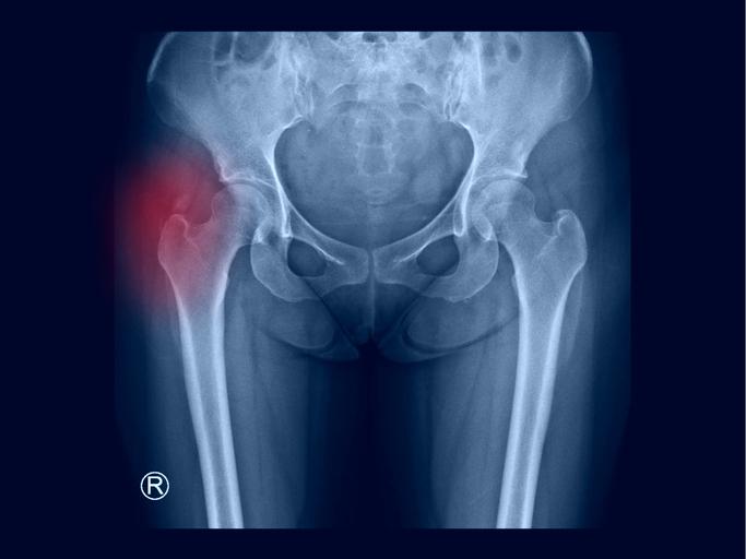 Calcificaciones en la cadera sintomas dolor baja laboral tratamiento fisioterapia zaragoza