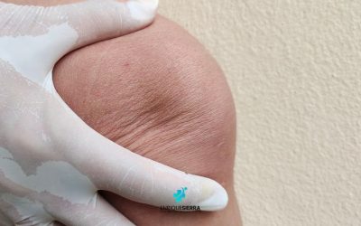 Osgood-Schlatter en adultos: como solucionar